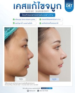 Review Nose Silicone