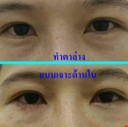 เจาะถุงไขมันตาล่าง