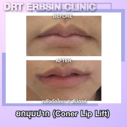 lipcornerlift