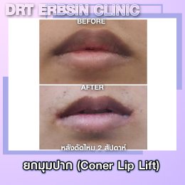 lipcornerlift