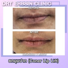 lipcornerlift