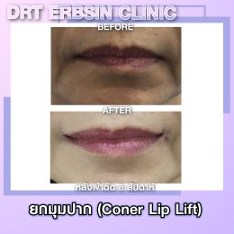 lipcornerlift