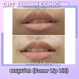 lipcornerlift