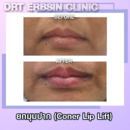 lipcornerlift