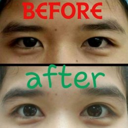 medialcanthoplasty1