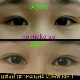 medialcanthoplasty1