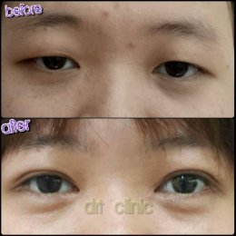 medialcanthoplasty1