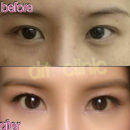 medialcanthoplasty1