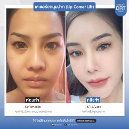รีวิวศัลยกรรมยกมุมปาก (Lip Corner Lift)