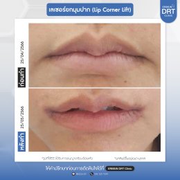 รีวิวศัลยกรรมยกมุมปาก (Lip Corner Lift)