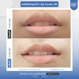 รีวิวศัลยกรรมยกมุมปาก (Lip Corner Lift)