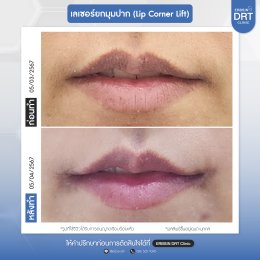รีวิวศัลยกรรมยกมุมปาก (Lip Corner Lift)