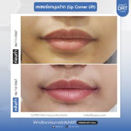 รีวิวศัลยกรรมยกมุมปาก (Lip Corner Lift)
