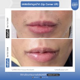 รีวิวศัลยกรรมยกมุมปาก (Lip Corner Lift)