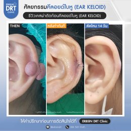 รีวิวศัลยกรรมคีลอยด์ใบหู (EAR KELOID)