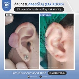 รีวิวศัลยกรรมคีลอยด์ใบหู (EAR KELOID)