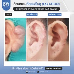 รีวิวศัลยกรรมคีลอยด์ใบหู (EAR KELOID)