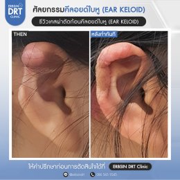รีวิวศัลยกรรมคีลอยด์ใบหู (EAR KELOID)