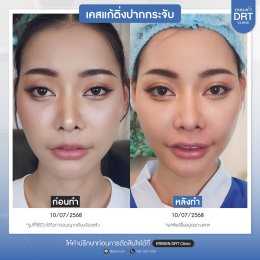 รีวิวศัลยกรรมตัดริมฝีปากบาง (ปากกระจับ) - Lip Surgery