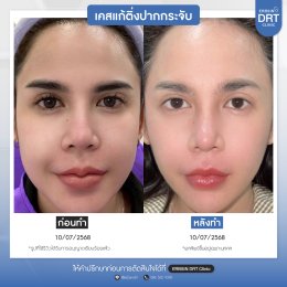 รีวิวศัลยกรรมตัดริมฝีปากบาง (ปากกระจับ) - Lip Surgery