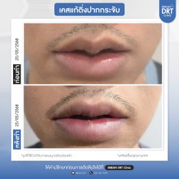 รีวิวศัลยกรรมตัดริมฝีปากบาง (ปากกระจับ) - Lip Surgery