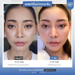 รีวิวศัลยกรรมตัดริมฝีปากบาง (ปากกระจับ) - Lip Surgery