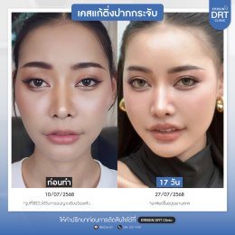 รีวิวศัลยกรรมตัดริมฝีปากบาง (ปากกระจับ) - Lip Surgery