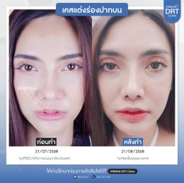 รีวิวศัลยกรรมตัดริมฝีปากบาง (ปากกระจับ) - Lip Surgery