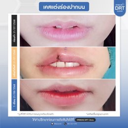 รีวิวศัลยกรรมตัดริมฝีปากบาง (ปากกระจับ) - Lip Surgery