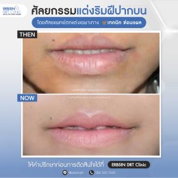 รีวิวศัลยกรรมตัดริมฝีปากบาง (ปากกระจับ) - Lip Surgery