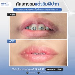 รีวิวศัลยกรรมตัดริมฝีปากบาง (ปากกระจับ) - Lip Surgery