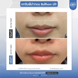 รีวิวศัลยกรรมยกริมฝีปาก BULLHORN