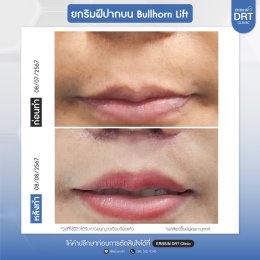 รีวิวศัลยกรรมยกริมฝีปาก BULLHORN