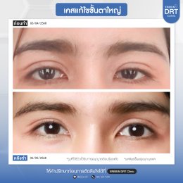 รีวิวแก้ไขศัลยกรรมตา