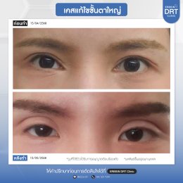 รีวิวแก้ไขศัลยกรรมตา
