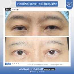 รีวิวแก้ไขศัลยกรรมตา