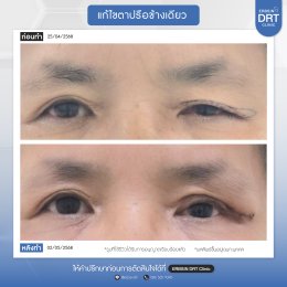 รีวิวแก้ไขศัลยกรรมตา
