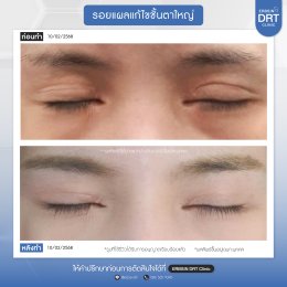 รีวิวแก้ไขศัลยกรรมตา
