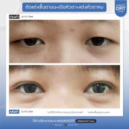 รีวิวแก้ไขศัลยกรรมตา