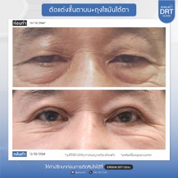 รีวิวแก้ไขศัลยกรรมตา