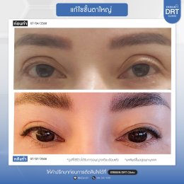 รีวิวแก้ไขศัลยกรรมตา