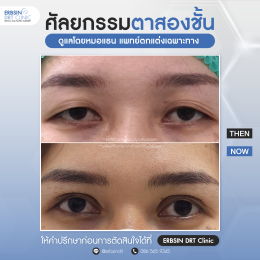 รีวิวแก้ไขศัลยกรรมตา