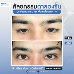 รีวิวแก้ไขศัลยกรรมตา