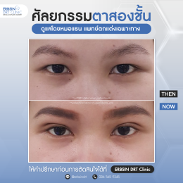 รีวิวแก้ไขศัลยกรรมตา
