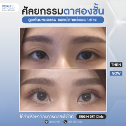 รีวิวแก้ไขศัลยกรรมตา