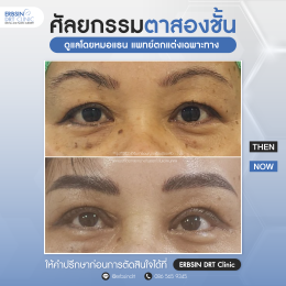 รีวิวแก้ไขศัลยกรรมตา
