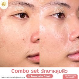 รวมรูปรีวิวโปรแกรมรักษาหลุมสิว