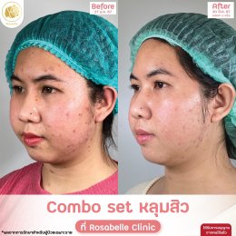 รวมรูปรีวิวโปรแกรมรักษาหลุมสิว