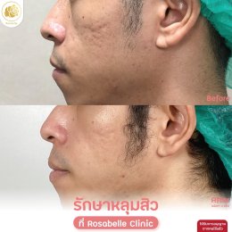 รวมรูปรีวิวโปรแกรมรักษาหลุมสิว