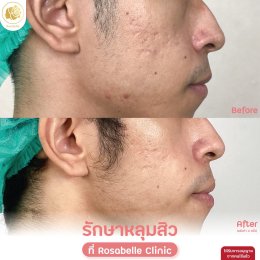 รวมรูปรีวิวโปรแกรมรักษาหลุมสิว
